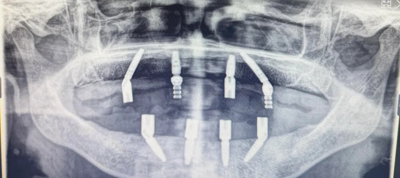 Radiografía panorámica de un caso All-on-4 en Medellín, cuatro implantes con prótesis fija (después)