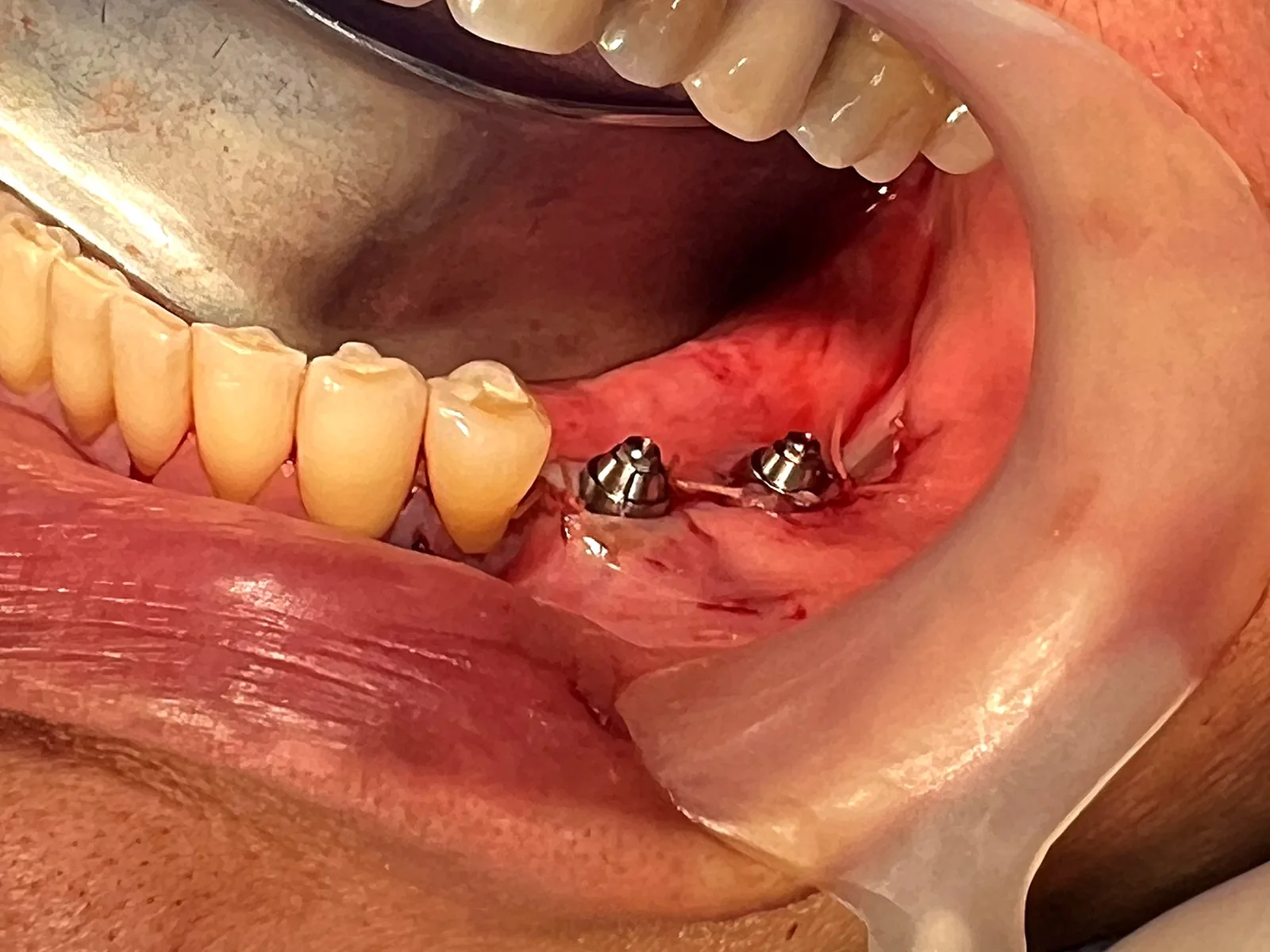 Procedimiento All-on-4 en Medellín — prótesis fija sobre 4 implantes